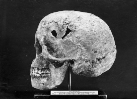A skull unearthed during the dig